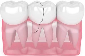 3D Cracked Teeth